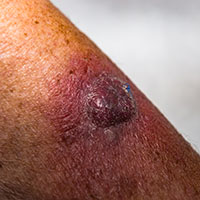 Squamous Cell Carcinoma