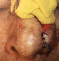 Repair of surgical defect (first stage) 3